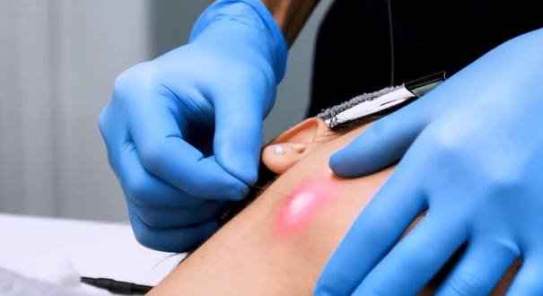 Endolifting: aplicaci&oacute;n de l&aacute;ser con microfibra &oacute;ptica