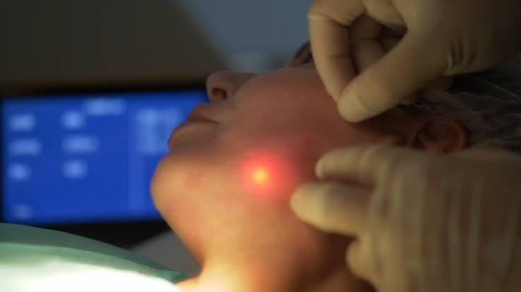 Endolifting: aplicaci&oacute;n de l&aacute;ser de diodo con microfibra &oacute;ptica en el rostro