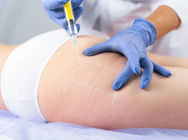 Microinyecciones de Alidya sobre el glúteo, con la zona marcada previamente