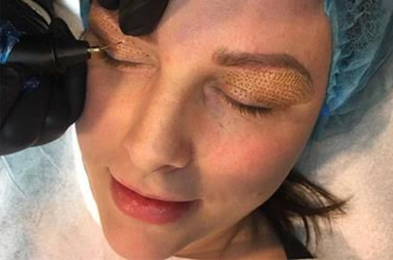 Blefaroplastia con plasma láser: aplicación del plasma sobre el párpado
