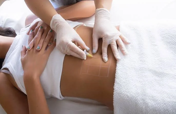Sesión de carboxiterapia corporal sobre el abdomen