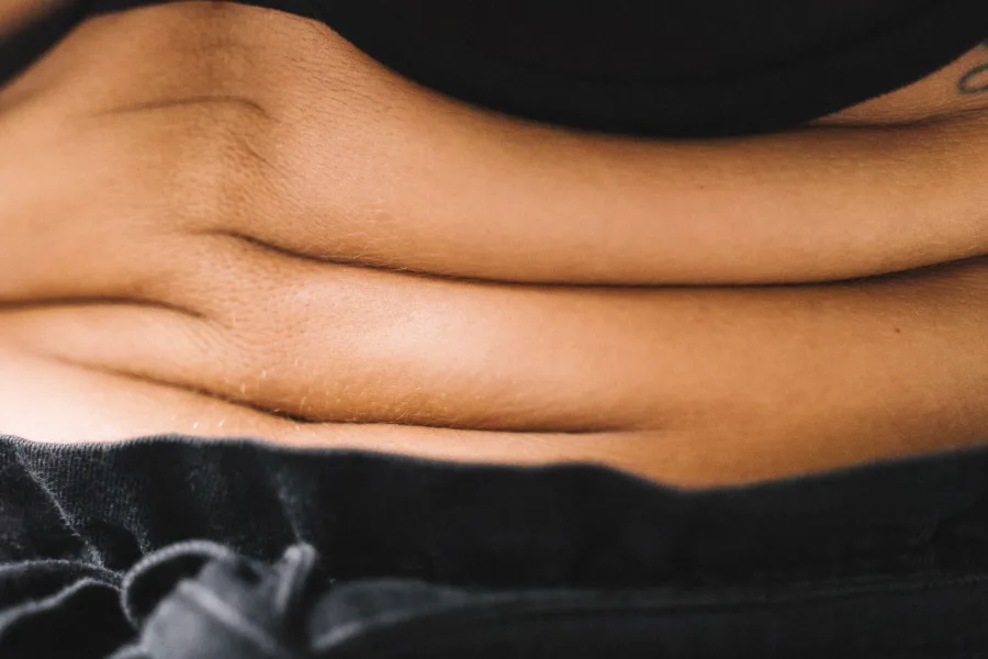 Evaluación del pliegue cutáneo abdominal antes de una sesión de carboxiterapia