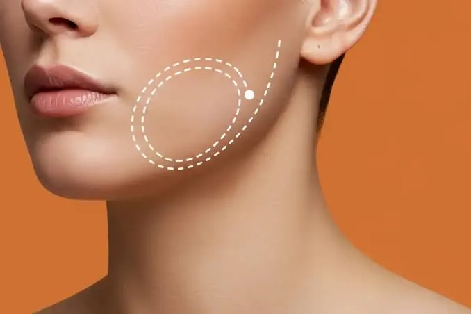 Marcación del contorno facial previa a una armonización facial