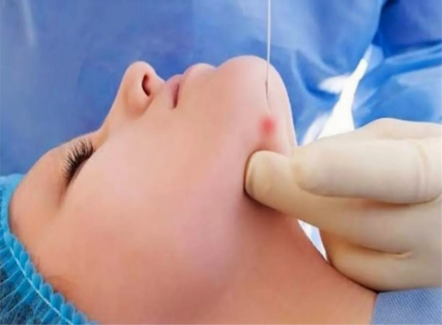 Endolifting: la microfibra óptica se desliza por debajo de la piel del rostro