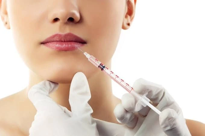 Aplicación de ácido hialurónico en el labio con técnica de relleno