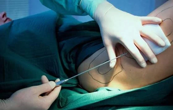 M.E.L.A Láser: introducción de la cánula con fibra óptica en la zona a tratar