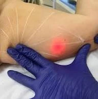 M.E.L.A Láser aplicado en la cara interna del brazo