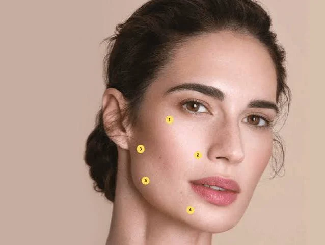 Puntos BAP marcados en el rostro para la aplicación de Profhilo