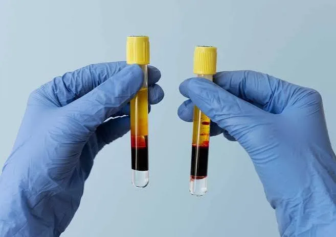 Tubos con plasma rico en plaquetas separado por centrifugación