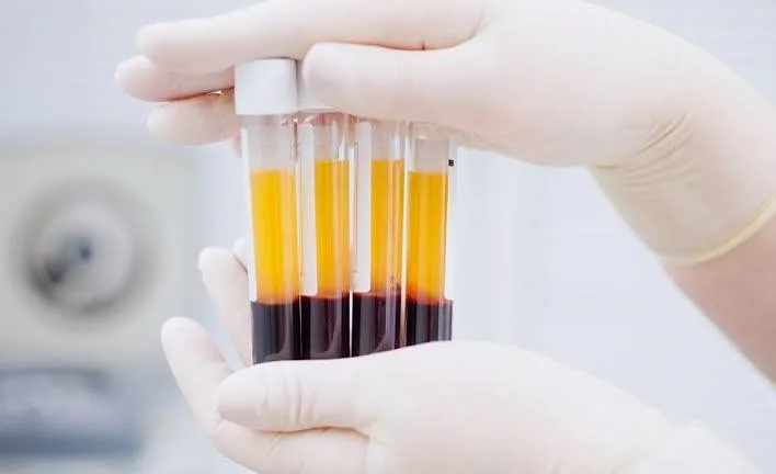 Tubos con plasma rico en plaquetas listos para su aplicación