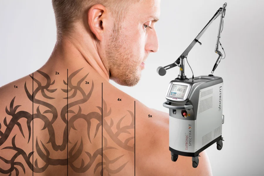 Sesión de remoción de tatuaje con láser Spectra en la espalda