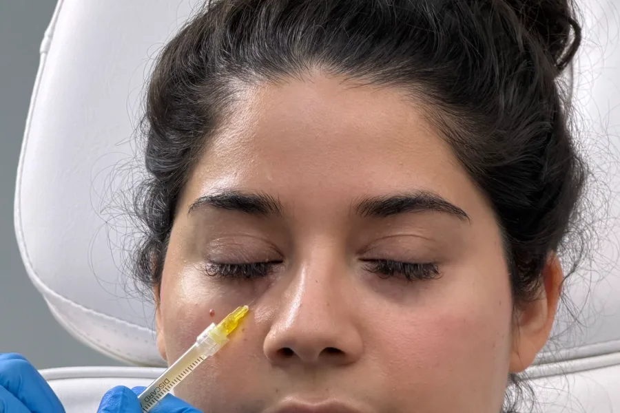 Aplicación de Sunekos en la zona infraorbitaria con aguja fina en consultorio médico